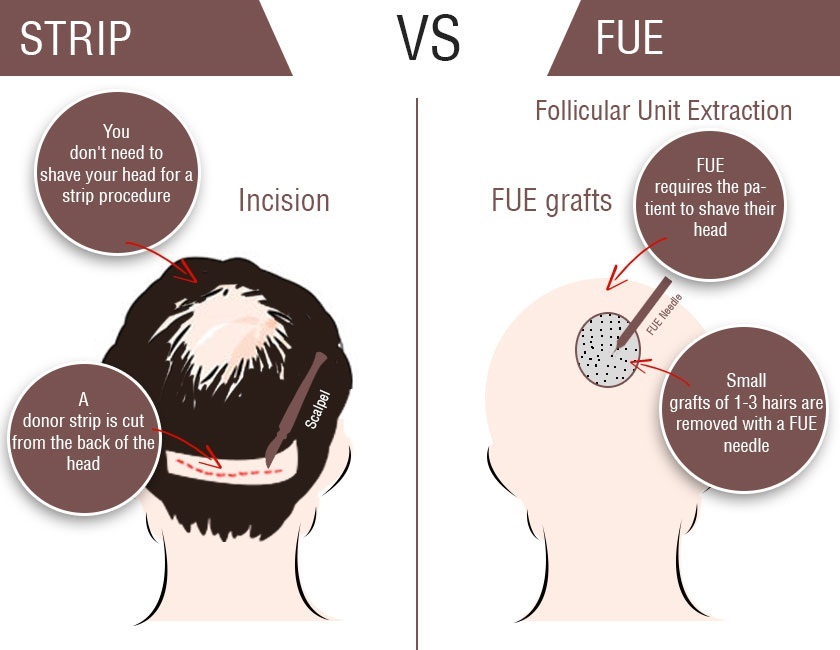 FUE vs Strip – Hair Experts